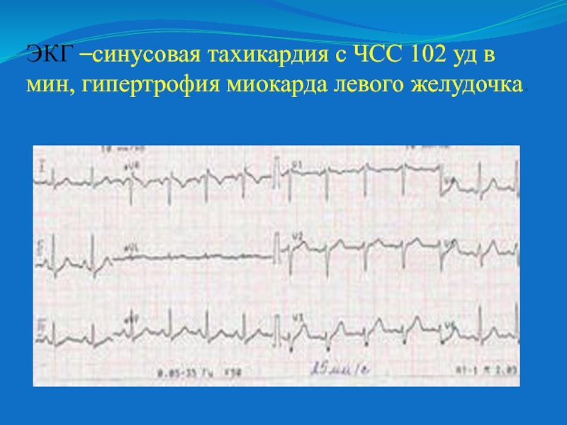 Экг синусовый. ЭКГ тахикардия синусовый ритм. Синусовая тахикардия с ЧСС 100-92. Синусовый ритм 100 уд в минуту. ЭКГ ритм синусовый ЧСС 82 В минуту ЭОС нормальное ГЛЖ.