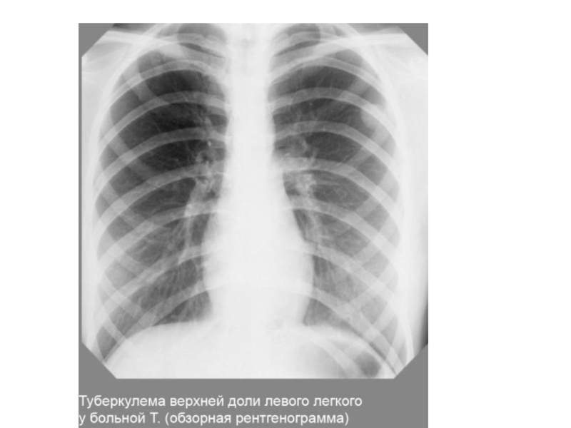 Реферат: Туберкулема правого легкого