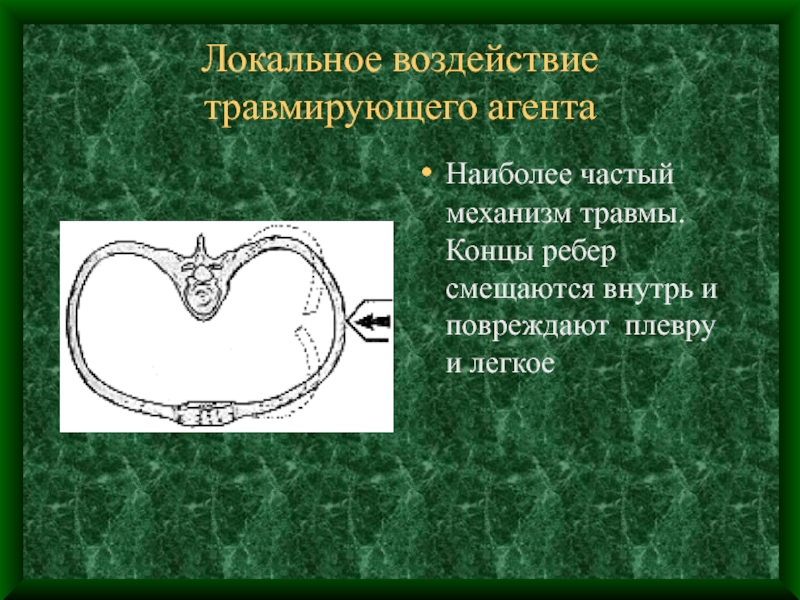 Травма груди презентация