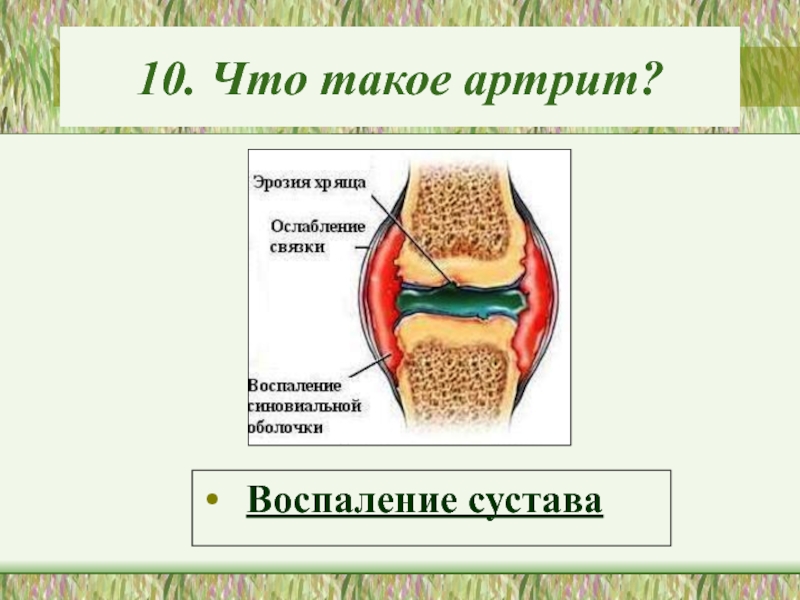 Болезни суставов презентация