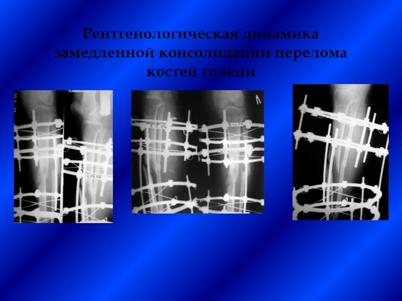 Замедленная консолидация презентация