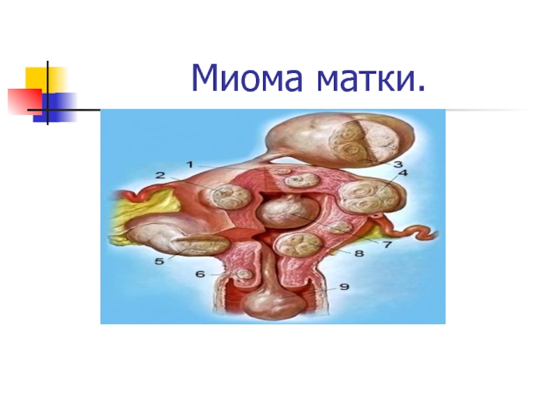 Презентация Миома матки