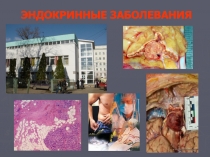 Эндокринные заболевания 