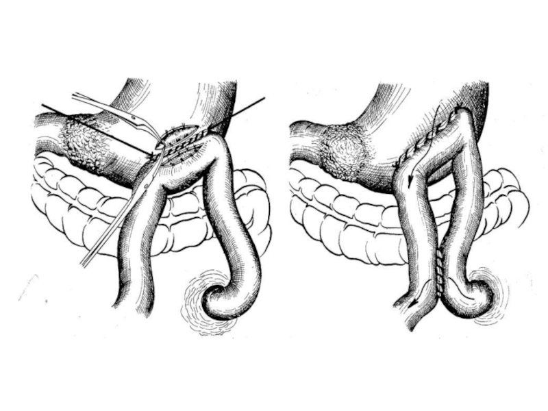 Тонкокишечный свищ. Гастростома, колостома,. Гастростома и еюностома. Еюностома по Майдлю техника. Колостома непроходимость.