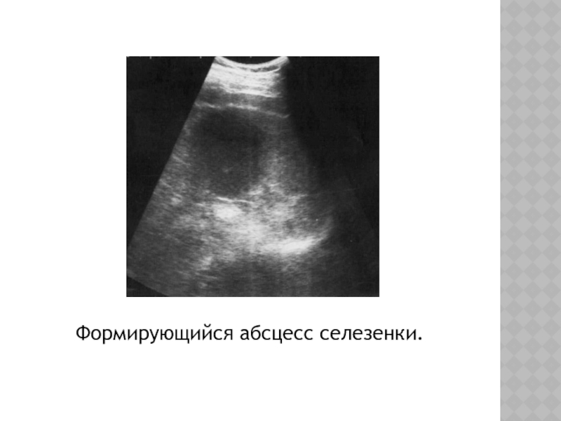 Заболевания селезенки презентация