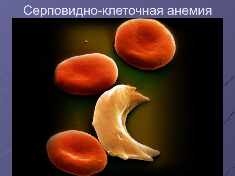 Серповидно клеточная анемия фото