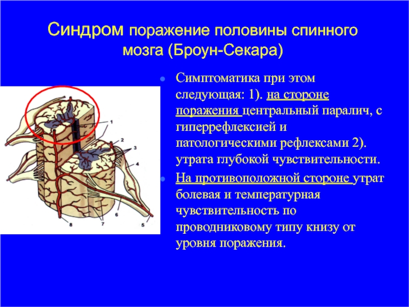 Поражение половины спинного мозга