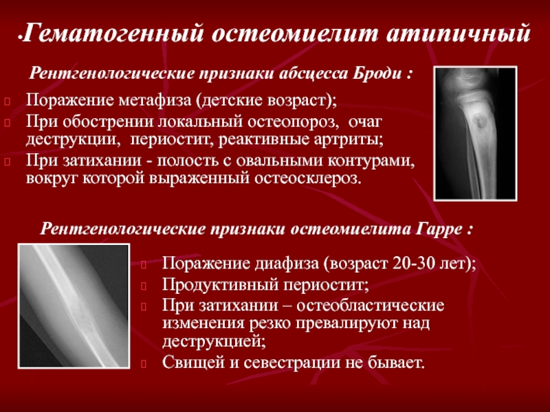 Острый гематогенный остеомиелит диагностика. Остеомиелит рентгенодиагностика. Гематогенный остеомиелит. Периостит и остеомиелит. Формы хронического остеомиелита.