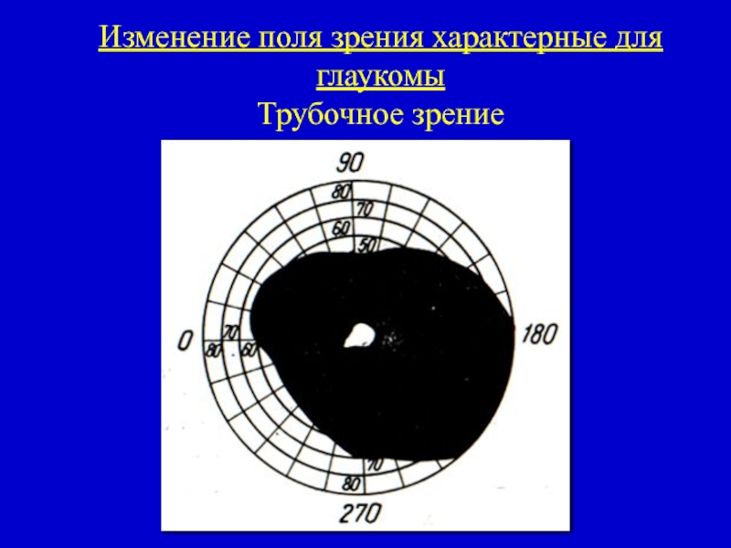 Как изменяется поле зрения. Поля зрения при глаукоме периметрия. Сужение полей зрения трубочное. Периметрия при глаукоме по стадиям. Периметрия при открытоугольной глаукоме 1 степени.