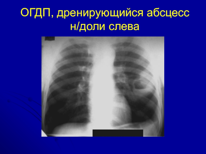 Острая пневмония у детей презентация