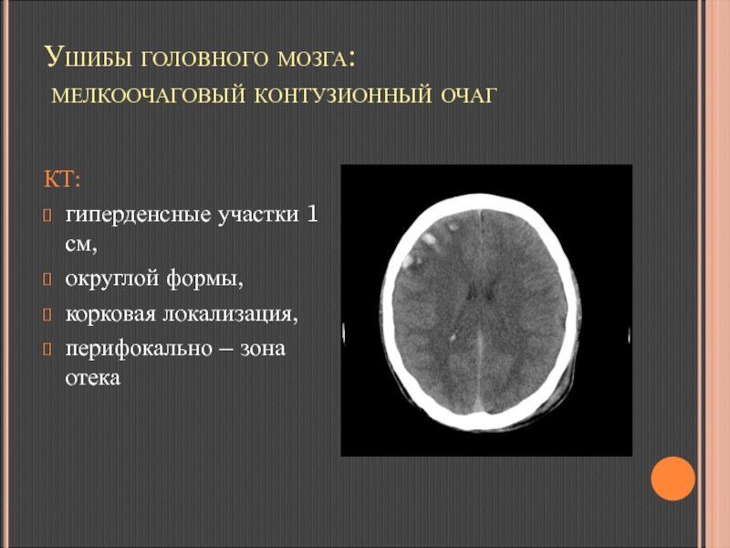 Гиперденсные структуры на кт изображениях