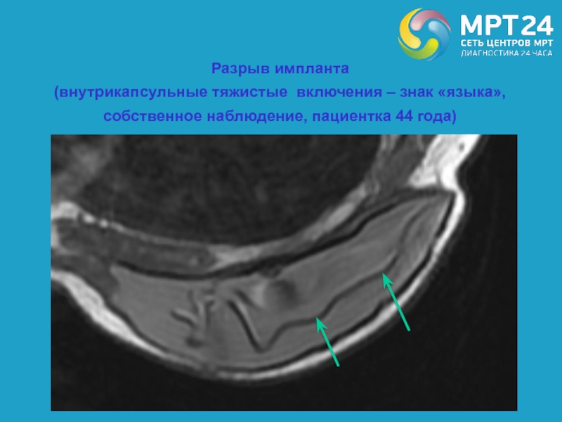 Имплант и мрт можно ли. Разрыв импланта молочной железы на кт. Внутрикапсульный разрыв импланта мрт.