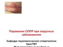 Поражение СОПР при вирусных заболеваниях 
