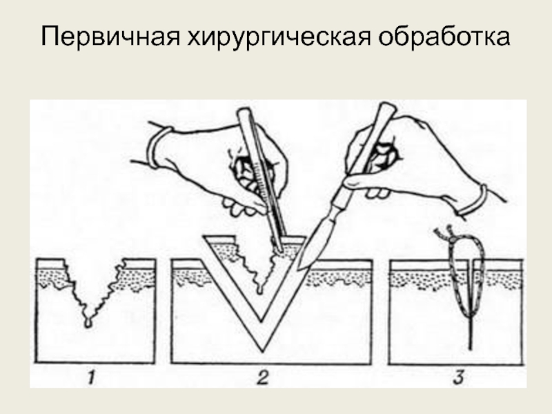 Инструменты для пхо раны