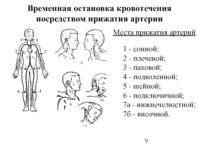 Места прижатия артерий при кровотечениях рисунок с подписями