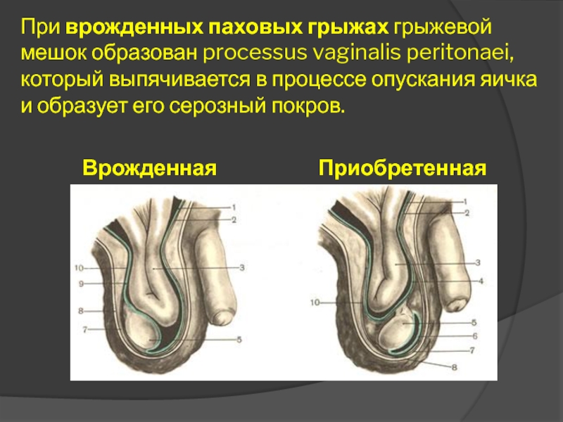 Опускаются яички у новорожденных. Паховая грыжа грыжевой мешок.