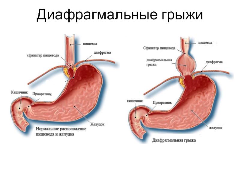 Диафрагмальная грыжа. Диафрагмальная грыжа симптомы. Диафрагмальная грыжа у детей клинические рекомендации. Диафрагмальная грыжа симптомы диагностика.