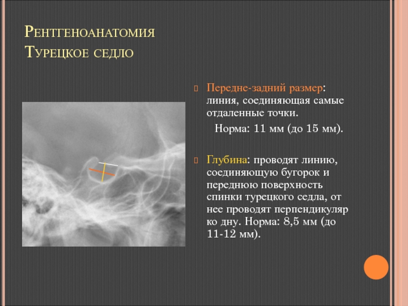 Описание рентгена нормы. Турецкое седло рентген норма. Турецкое седло рентген описание Размеры. Турецкое седло рентген описание. Турецкое седло рентген норма описание.