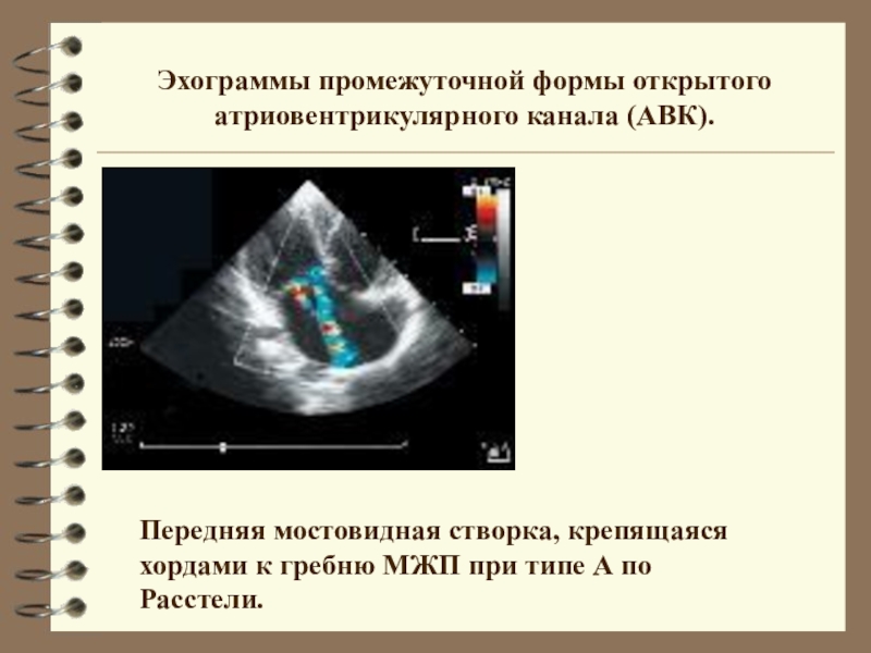 Открытый атриовентрикулярный канал презентация