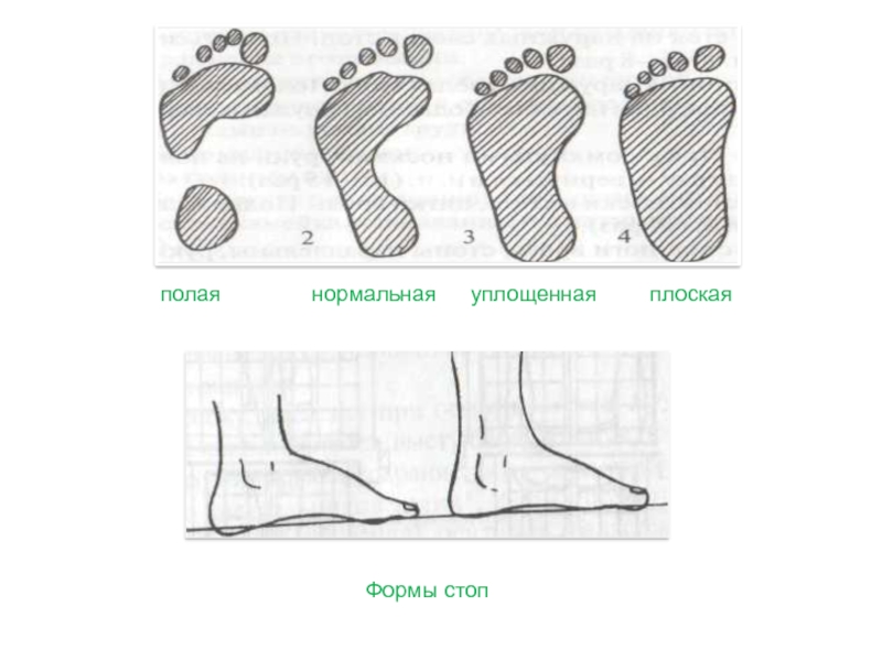 Форма стопы. Нормальная форма стопы. Стопа нормальная уплощенная плоская. Формы стопы уплощенная стопа.