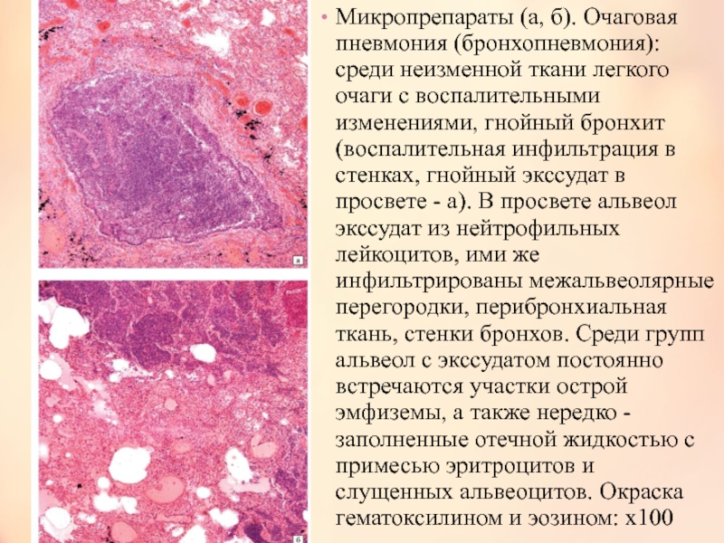 Жировая дегенерация костного мозга