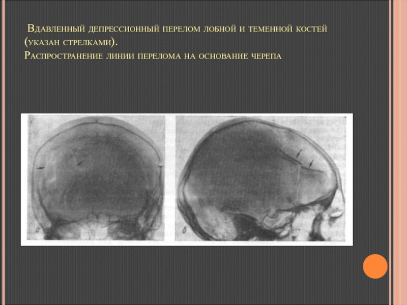 Перелом основания черепа карта вызова