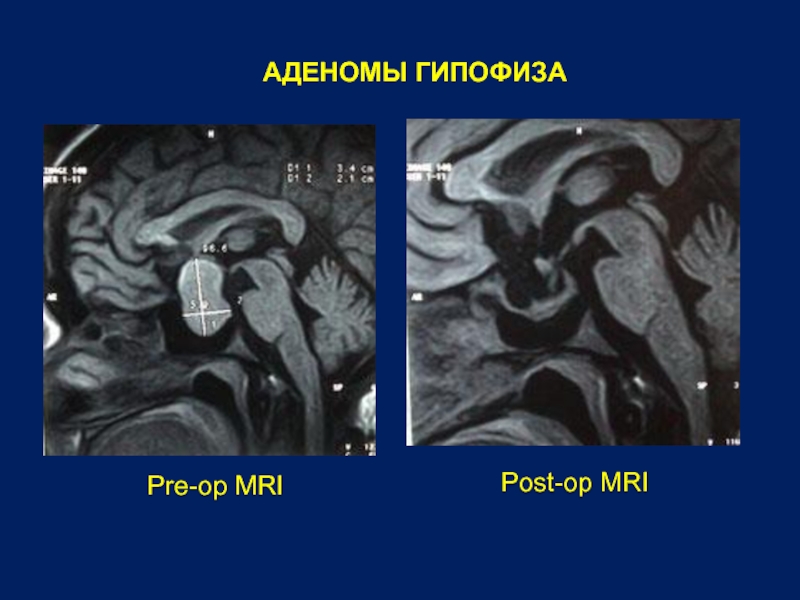 Микроаденома гипофиза. Воронка гипофиза мрт. Триада аденомы гипофиза. Гипофиз на кт в норме.