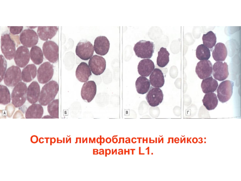 Лимфобластный лейкоз. Лимфобластный лейкоз l1. Острый лимфобластный лейкоз л1. Острый лимфобластный лейкоз миелограмма. Острый лимфобластный лейкоз l2.