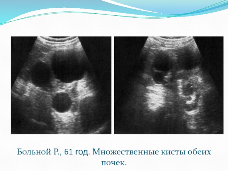 Киста левой почки. Кальцинированная киста почки на УЗИ. Множественные кисты обеих почек. Многочисленные кисты в почках.