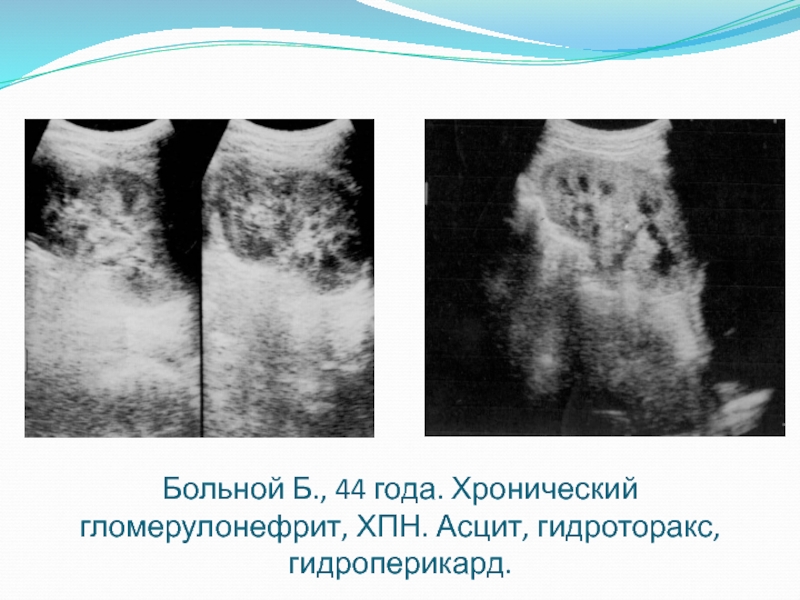 Асцит при сердечной недостаточности. Асцит гидроторакс гидроперикард. Хронический гломерулонефрит с ХПН. Асцит при почечной недостаточности.