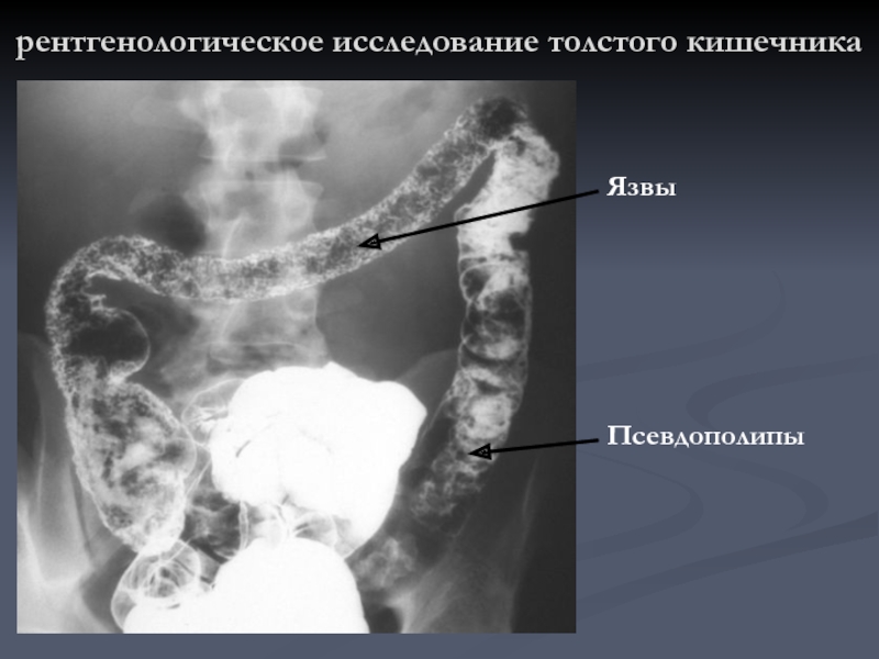 Исследование толстой