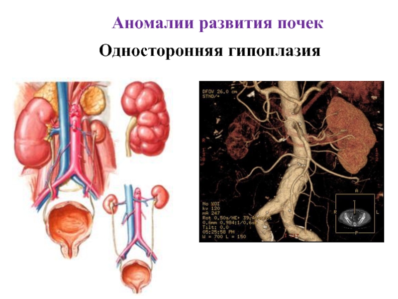 Аномалии развития почки картинки