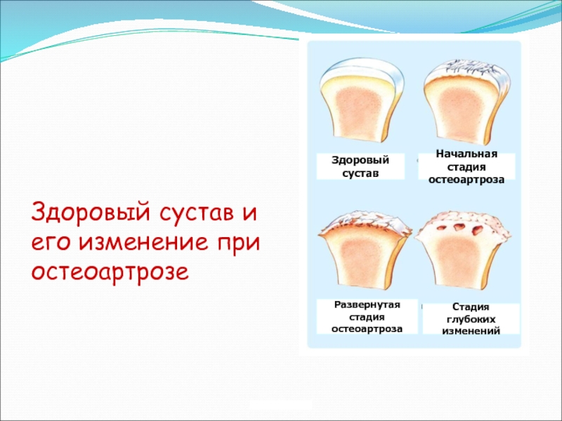 Остеоартроз код