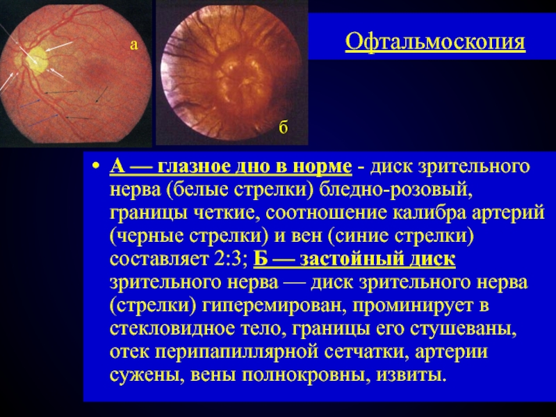 Изображение глазного дна при прямой офтальмоскопии