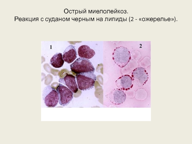 Лейкозы пропедевтика презентация