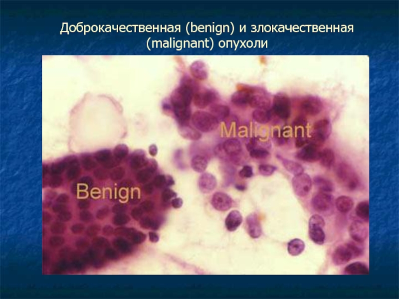 Доброкачественная опухоль рисунок