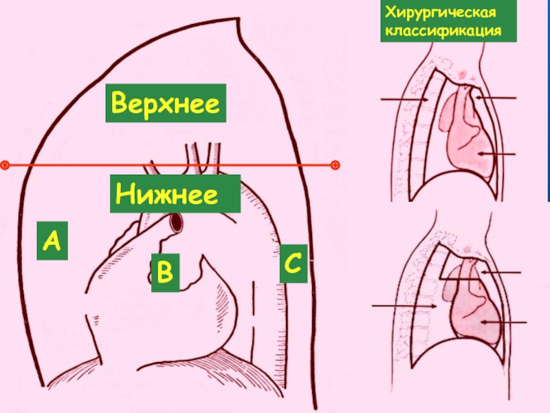 Опухоли легких и средостения