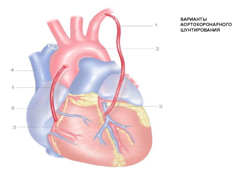 Аортокоронарное шунтирование схема операции