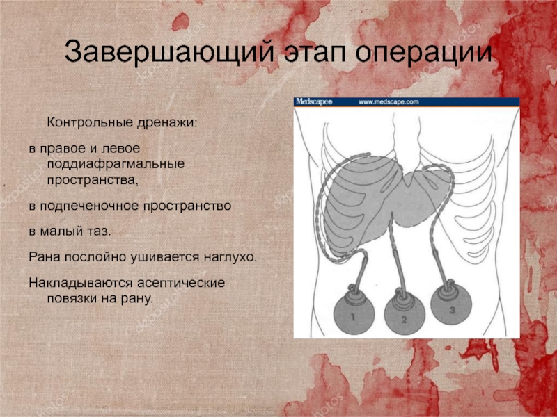 Завершение операции. Завершающий этап операции. Трансплантация печени презентация. Завершающему этапу операции. Правое и левое поддиафрагмальные пространства.