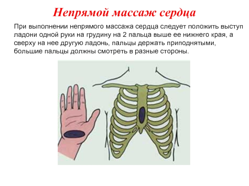 При выполнении непрямого массажа сердца следует положить выступ ладони одной руки на грудину на 2 пальца выше