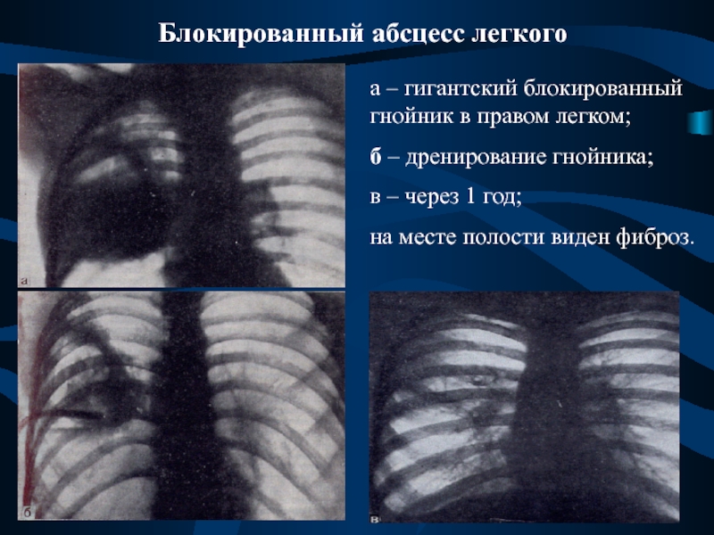 Нагноительные заболевания легких презентация