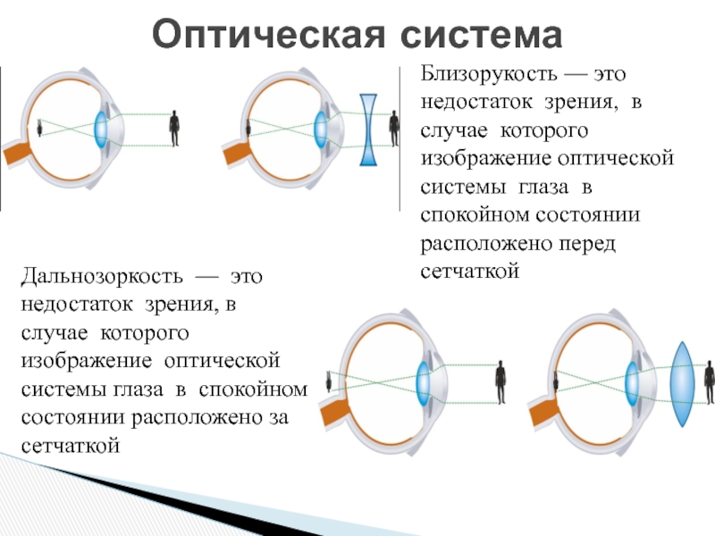 Оптическая система глаза строит изображение далеких предметов за сетчаткой какой