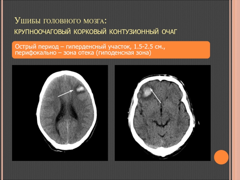 Гиперденсный участок в серошкальном изображении