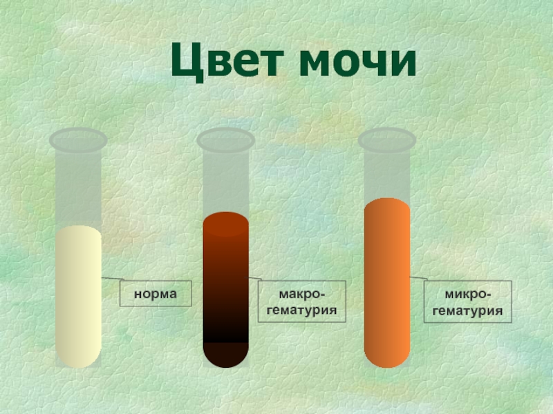 Моча песок камни. Цвет мочи. Нормальный цвет мочи. Цвет мочи норма. Цвет мочи при камнях в почках.