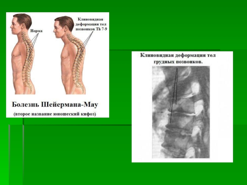 Деформация позвонков. Клиновидная деформация тела позвонка т6. Клиновидная деформация т4. Клиновидная деформация th11. Клиновидная деформация l2 позвонка.