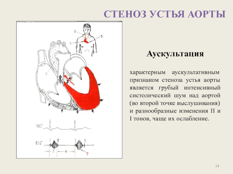 Для аускультативной картины недостаточности митрального клапана характерно