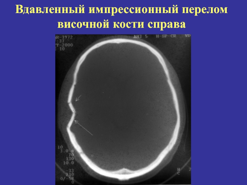 Импрессионный перелом. Импрессионный перелом свода черепа. Импрессионный перелом черепа на кт. Вдавленный перелом теменной кости кт. Импрессионный перелом лобной кости.