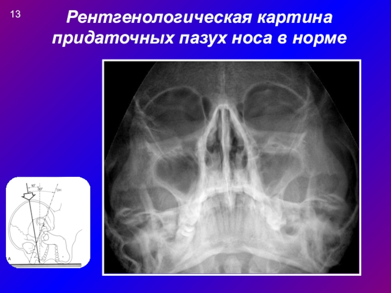 Рентгенологическая картина синусита