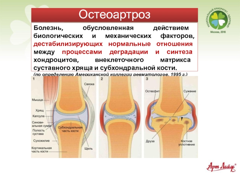 Остеоартроз патогенез