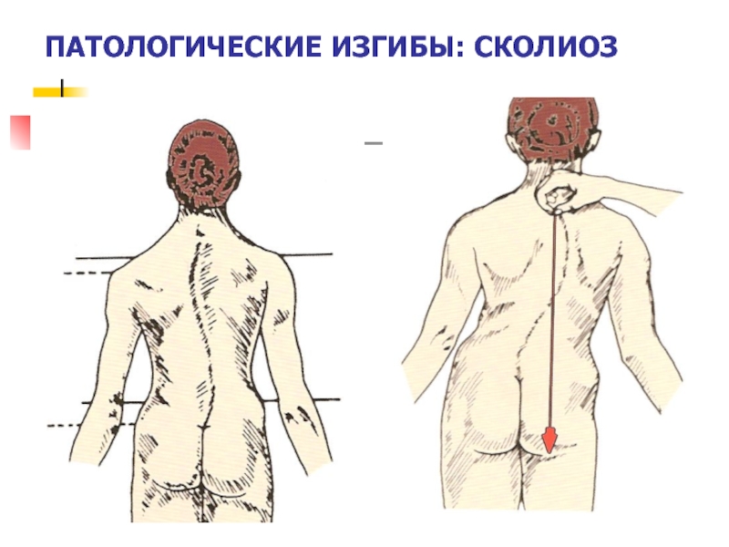 Боль в спине презентация